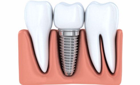 Dental Implants, Surrey Dentist