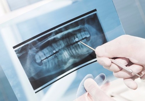 Digital Dental X-Rays, Surrey Dentist