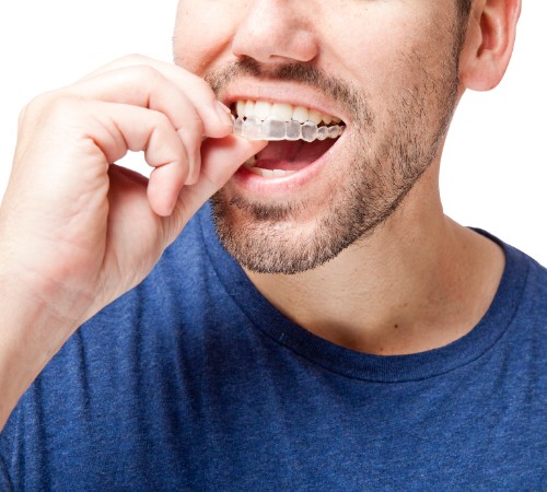 Invisalign®, Cloverdale Crossing Dental Group